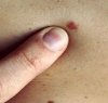 https://www.tp24.it/immagini_articoli/10-11-2015/1447140677-0-in-sicilia-il-melanoma-cutaneo-colpisce-700-persone-ogni-anno.jpg